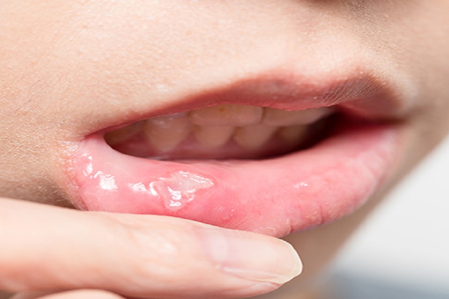 types-of-recurrent-oral-ulcers-panda-oral