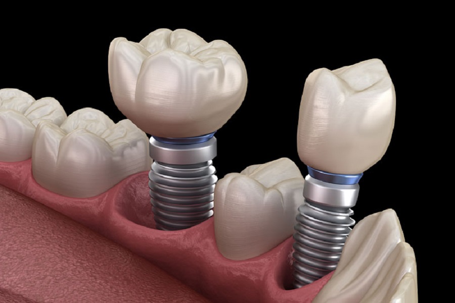 How Long Does It Take To Get A Dental Implant After A Tooth Extraction